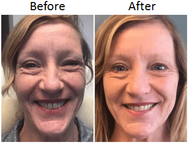 Dermal Filler & Botox Cosmetic by Debra Boyte, RN, BSN
