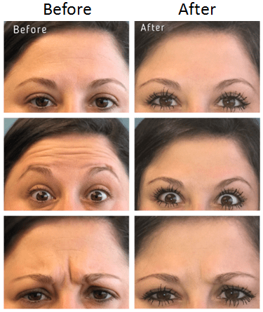 Xeomin Injection, Forehead & Eyebrow Line by Debra Boyte, RN, BSN