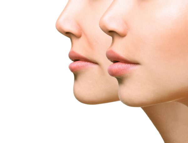 different types of facial fillers and how long they last - Beauti Science Med Spa, Plano, Texas