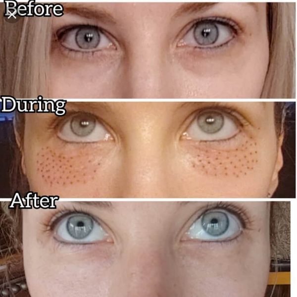 A woman 's eyes before and during the procedure.