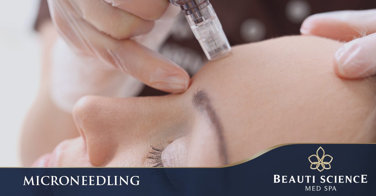 Microneedling Cosmetic Treatment in Plano